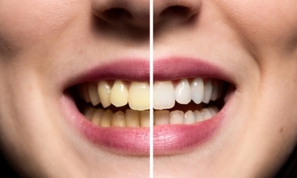 Ce produse afectează culoarea dinților, viața sănătoasă