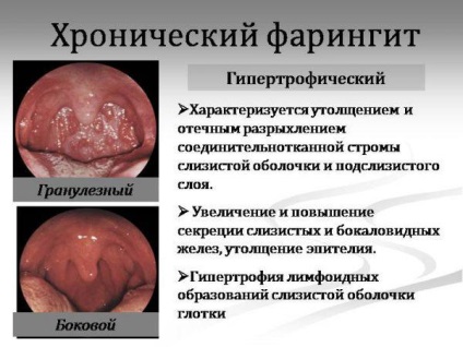 Cum să tratați faringita la domiciliu la adulți remedii rapid populare, acute și