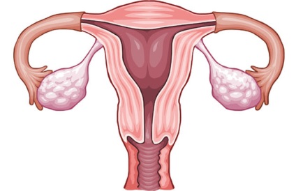 Cum să tratați semnele hidrosalpinx de obstrucție a trompelor uterine