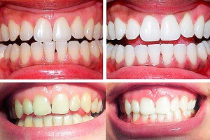 Ce albire dinti este cel mai sigur efect post-albire