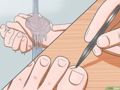 Cum să eliminați un splinter adânc