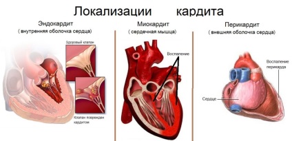 Cardiovascular non reumatice, reumatice, la copii, tratament