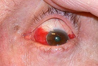 Cataracta - o operație de înlocuire a lentilei ochiului, care sunt mai bune pentru cataractă