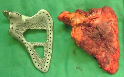 Medicii chinezi au tipărit și au implantat oasele umărului și pelvisului