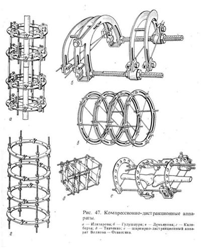 Metoda de distragere prin compresie a osteosintezei în traumatologie și ortopedie