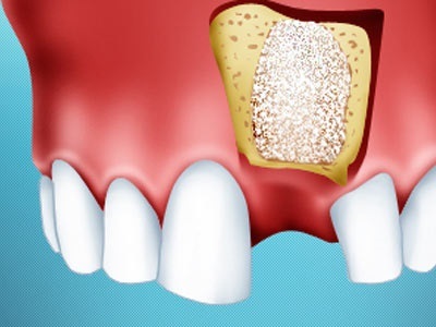 Plasticitatea osoasă pentru implantarea dinților - maestru
