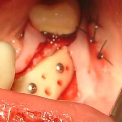 Plasticitatea osoasă pentru implantarea dinților - maestru