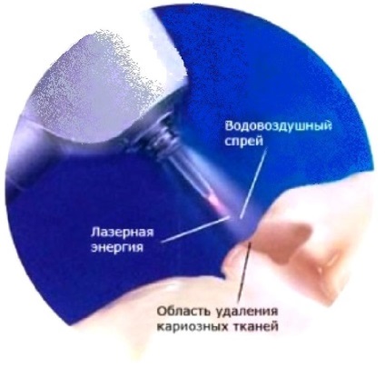 Tratamentul cariilor cu laser în Voronezh prețurile, recenzii și adresele clinicilor