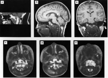 Tratamentul neoplasmelor bazei craniului