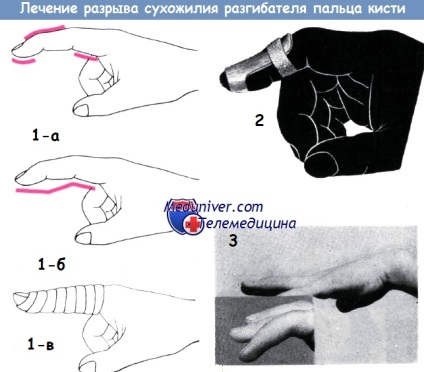 Tratamentul leziunilor tendoanelor extensorilor mâinii în partea distală și proximală a falangiei