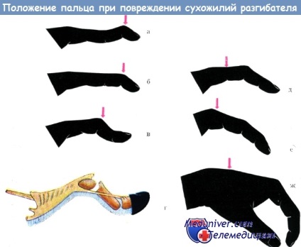 A kéz extenzorjai inak sérüléseinek kezelése a phalanx disztális és proximális részében