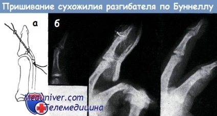 Tratamentul leziunilor tendoanelor extensorilor mâinii în partea distală și proximală a falangiei