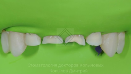 Tratamentul de abraziune a dintilor - stomatologie a medicilor kopylovyh