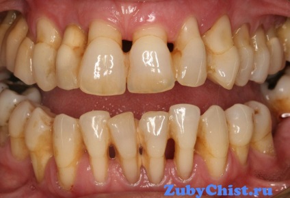 Stomatologie și curățarea dinților pentru parodonție, recomandată de dentiști