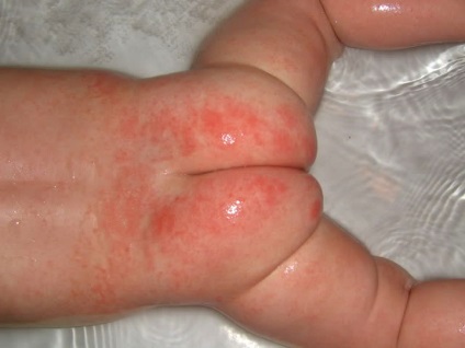 Tratam dermatita scutec la nou-nascuti