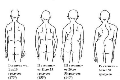 Scolioza stângă și dreaptă a coloanei vertebrale toracice și lombare