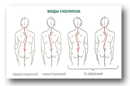 Scolioza stângă și dreaptă a coloanei vertebrale toracice și lombare