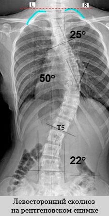 A mellkasi és ágyéki bal oldali scoliosis, kezelés