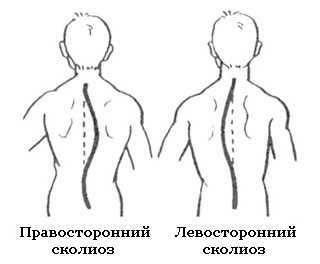 A mellkasi és ágyéki bal oldali scoliosis, kezelés