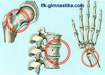 LFK - gimnastica pentru osteoporoza