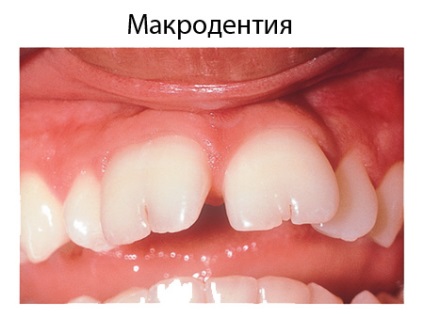 Macrodentia și microdenismul sunt prea mari și foarte mici dinții