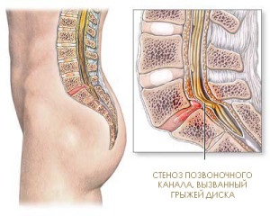 Metodele folclorice pentru tratamentul herniei intervertebrale