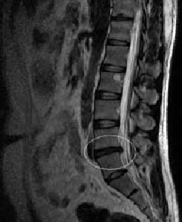 Hernia intervertebrală - 