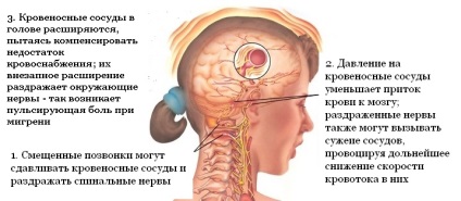 Migrenă este un medicament bazat pe dovezi pentru toți