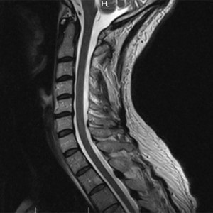 Murtul coloanei vertebrale cervicale - informații despre procedura de diagnosticare