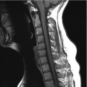 Murtul coloanei vertebrale cervicale - informații despre procedura de diagnosticare