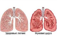 Cisztás fibrózis tünetei, kezelése, jelek, okok, diagnózisok, megelőzés