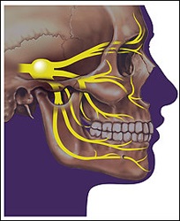 Nevralgia nervului trigeminal