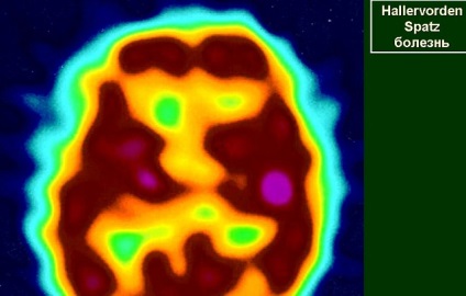 Neurodegenerarea simptomelor glarvorden-pătrat, tratament, speranța de viață