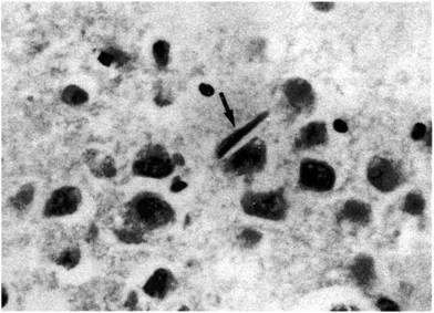 Neuromorfologie - psihiatrie de vârstă tânără