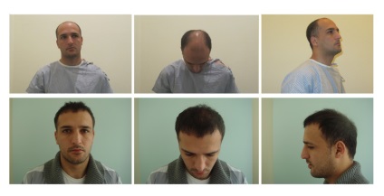 Alopecia, tratamentul pentru chelie - centru de sănătate pentru părul de sănătate a părului