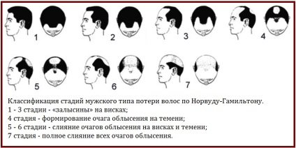 Alopecia, tratamentul pentru chelie - centru de sănătate pentru părul de sănătate a părului