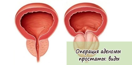 Funcționarea tipurilor de adenom de prostată, cum se face, cât este de mult