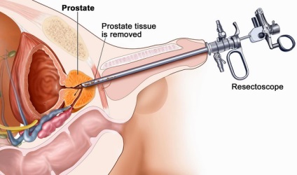 Funcționarea tipurilor de adenom de prostată, cum se face, cât este de mult