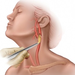 Operarea pe artera carotida cu complicatii si riscuri de ateroscleroza