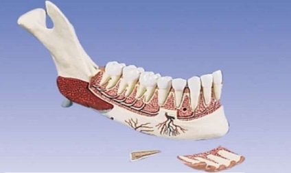 Osteomielita simptomelor și tratamentului maxilarului