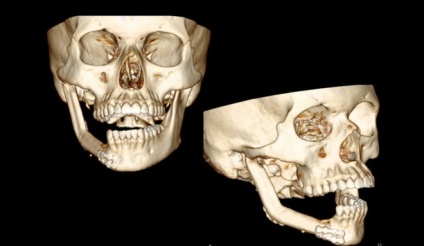 Osteomielita simptomelor și tratamentului maxilarului