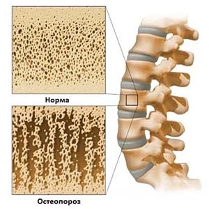 Osteoporoza tratamentului coloanei vertebrale, simptome, gimnastică, cum să tratăm dieta cervicală difuză,