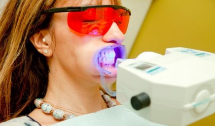 Metode de albire a dinților, caracteristici