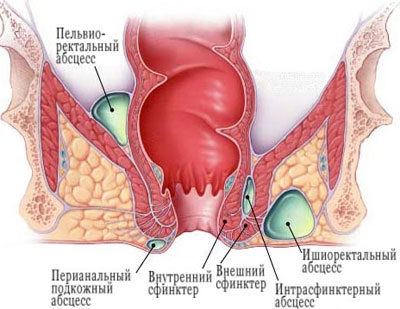 Simptomele și tratamentul paraproctitului