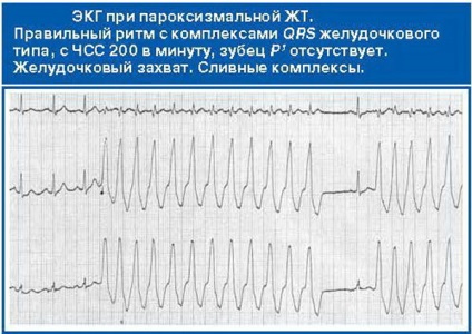 Tahicardia ventriculară paroxistică - ceea ce este, de exemplu, asistență de urgență, cum ar fi piroueta,