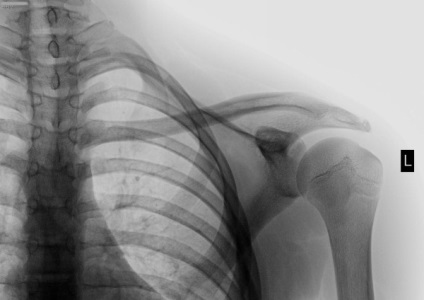 Fractura de humerus la copii primul ajutor, tratament, simptome, complicatii