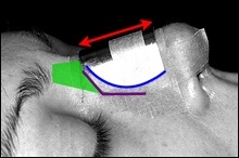 Ligare nazală, etape de operații, rinoplastie