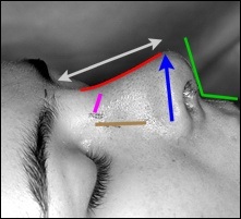 Ligare nazală, etape de operații, rinoplastie