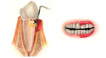 Periodontită - enciclopedie a stomatologiei