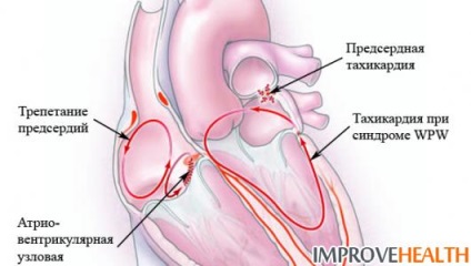 Elsősegély a tachycardia számára